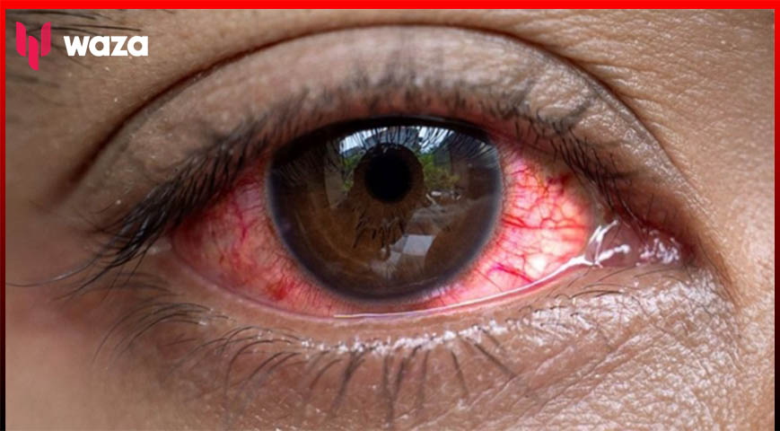 Mombasa County Raises Alert On Outbreak Of Red Eye Infection
